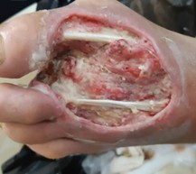 وکیوم تراپی زخم (NPWT) چیست؟ راهنمای کامل مراحل، هزینه و عوارض2